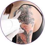 Tattoo removal procedures